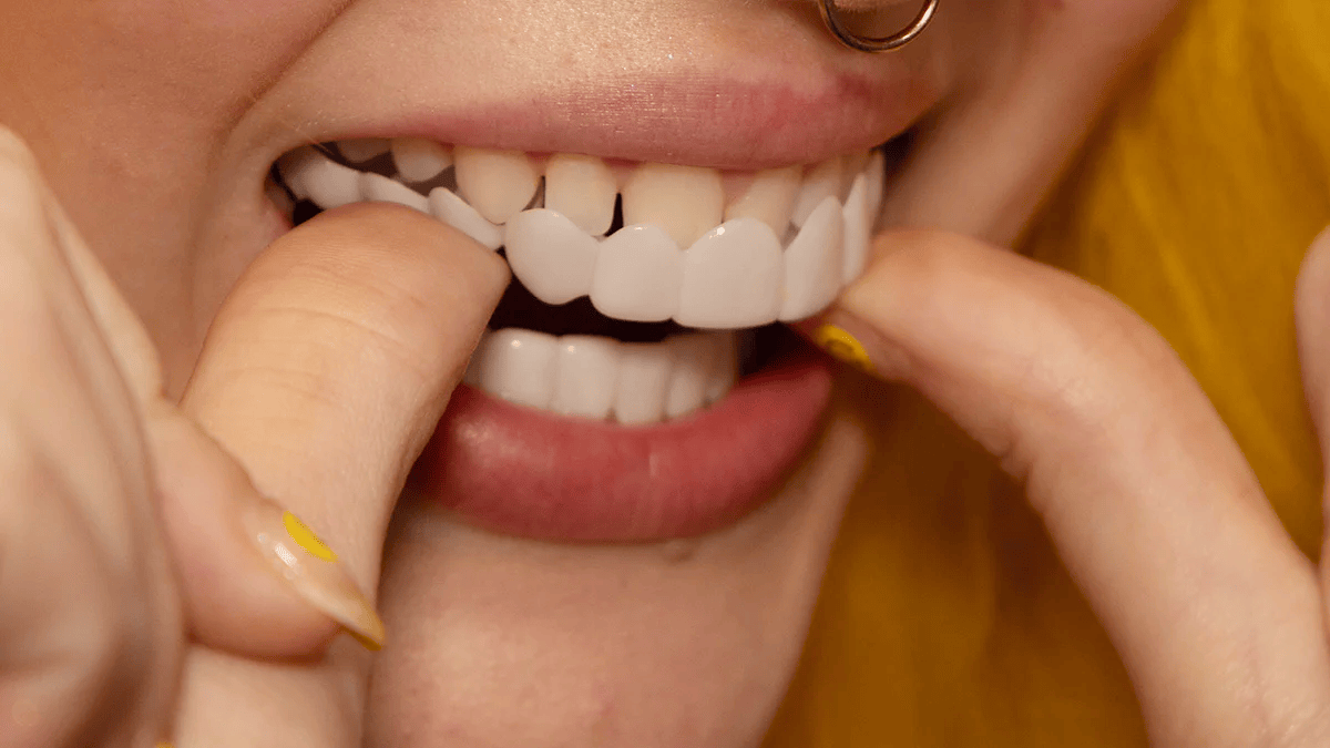 Snap on Smile Veneers - Instant Dental Transformation for Perfect Teeth