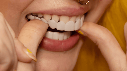 Snap on Smile Veneers - Instant Dental Transformation for Perfect Teeth