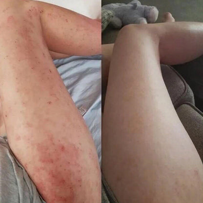 Healed My Eczema - Soothing Cream for Calming & Restoring Irritated Skin